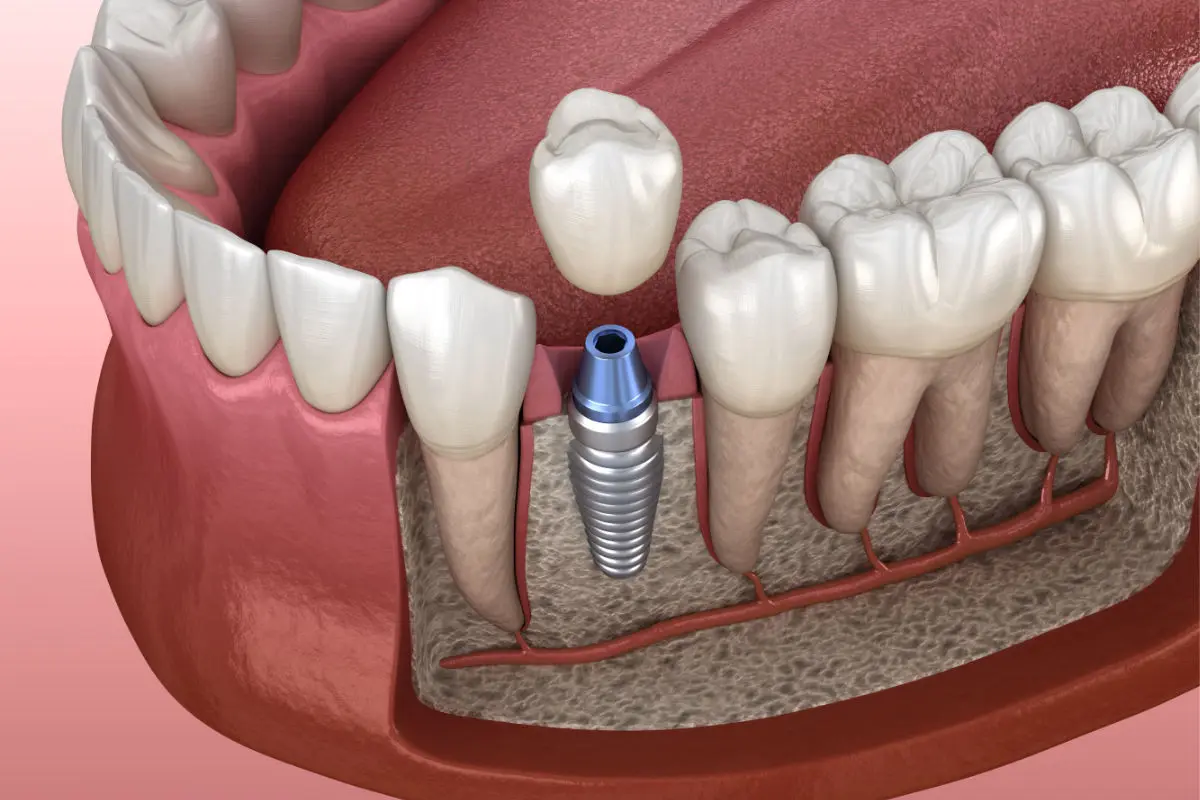 IMPLANTE DENTAL
