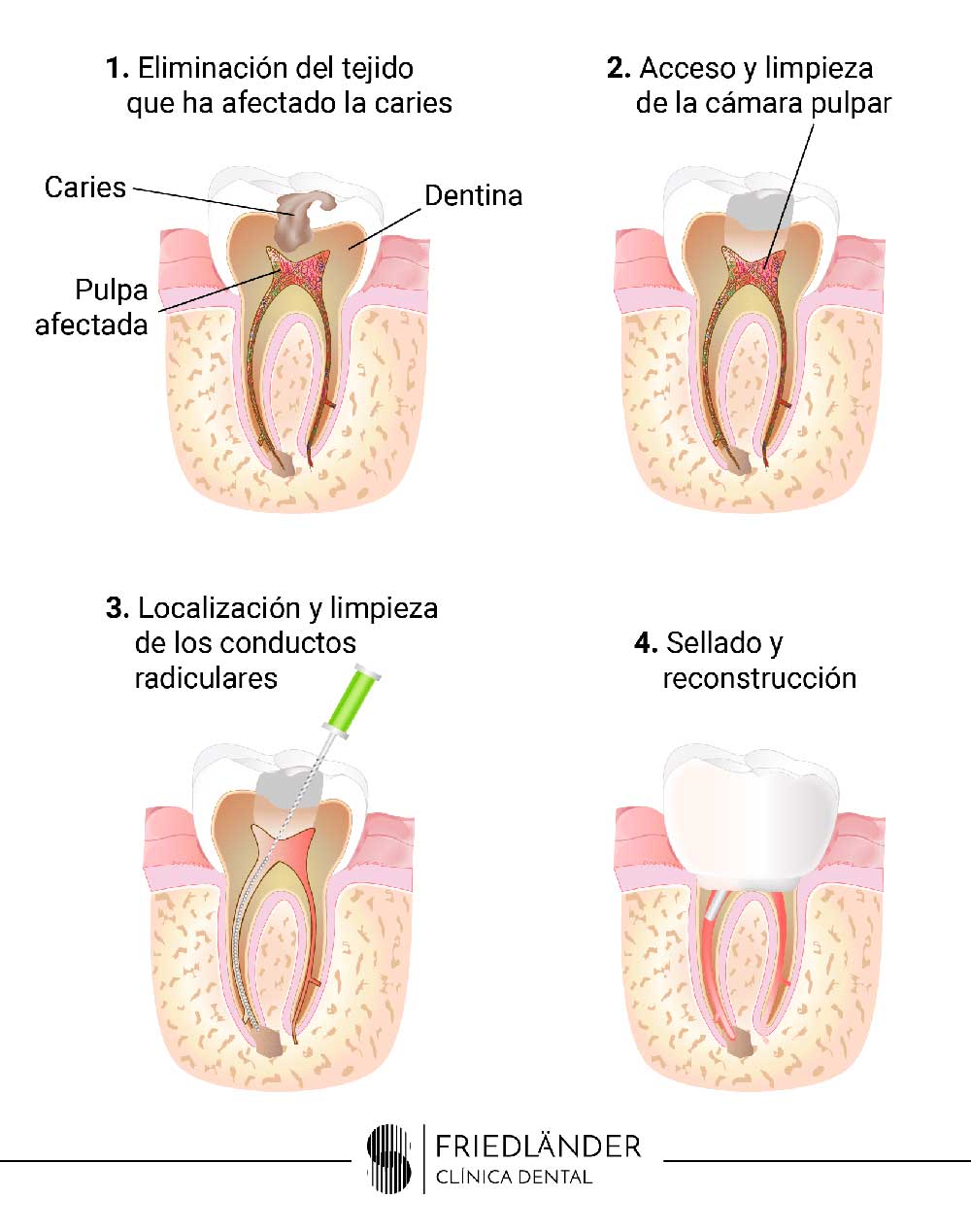 ENDODONCIA