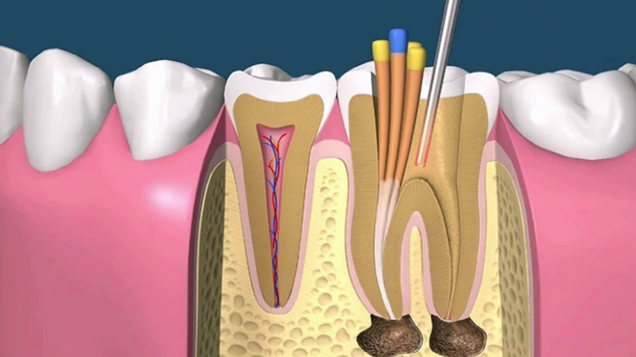 ENDODONCIA